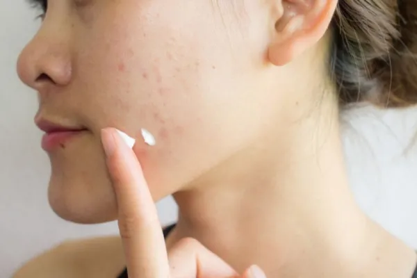 ¿Por qué una crema para el acné podría ocultar un riesgo inesperado para la salud?