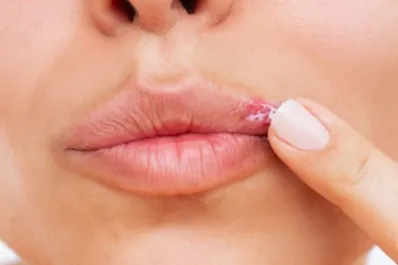 ¿Es un herpes o un grano en el labio? Aprendé a diferenciarlos y tratarlos
