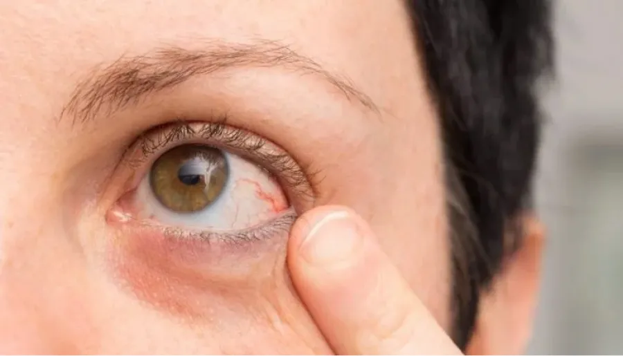 Melanoma ocular: cuál es la manchita en el ojo que anuncia un raro tipo de cáncer