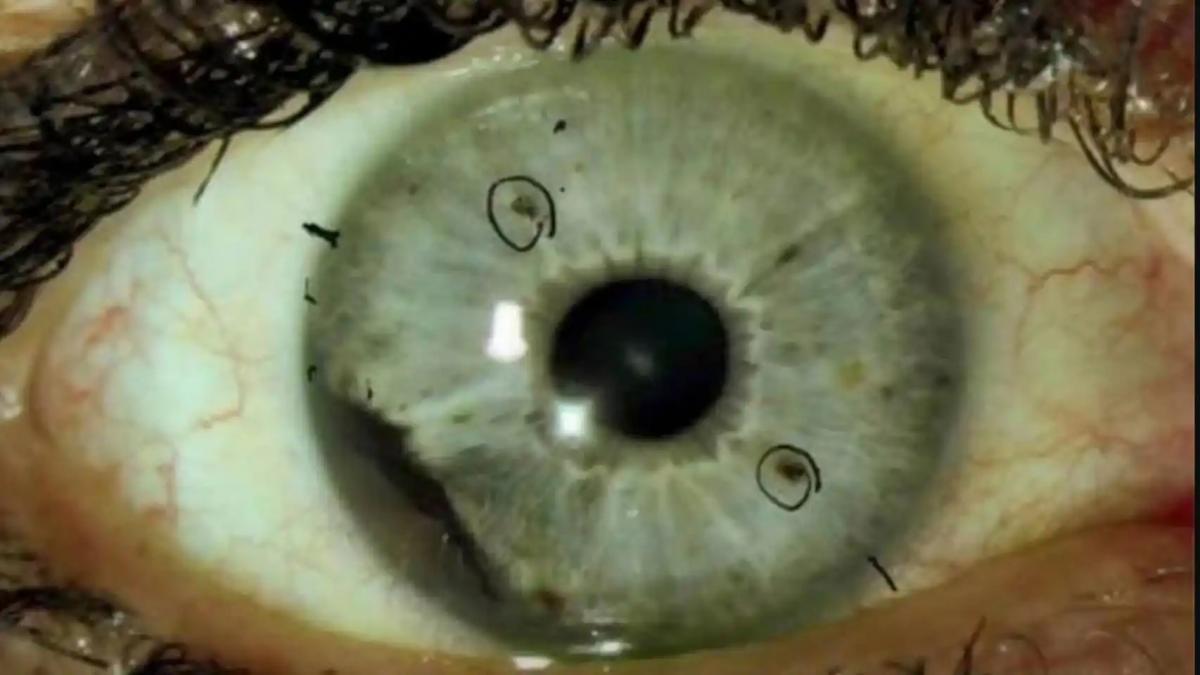 Melanoma ocular, el raro cáncer de ojo que está arrasando en Estados Unidos.