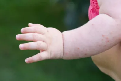 De qué se trata la sexta enfermedad y cómo prevenirla