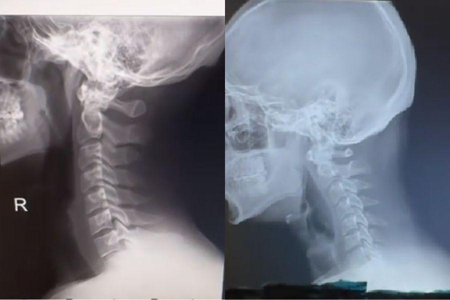 CUELLO TECNOLÓGICO. Una comparación de una columna vertebral normal versus la de una persona joven afectada por la tecnología./CAPTURA DE PANTALLA