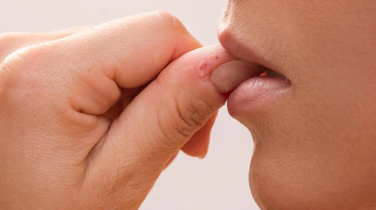 Cuáles son los síntomas de la sepsis, la mortal infección que se origina por morderse las uñas