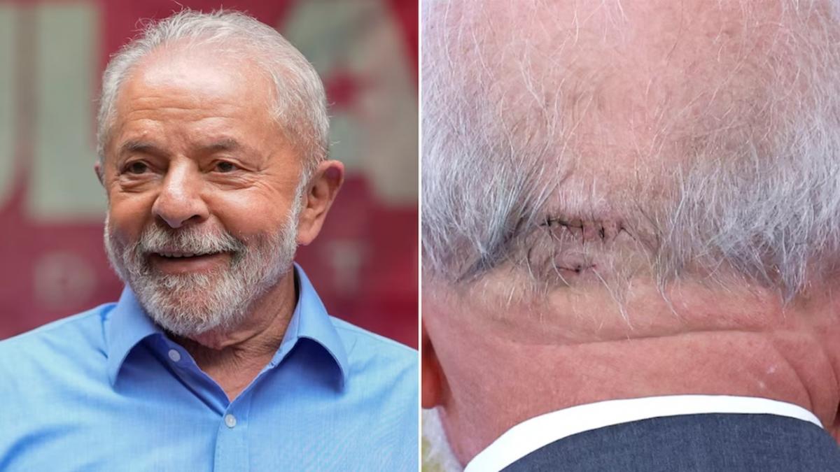 En Brasil, Lula da Silva fue operado de emergencia por una hemorragia intracraneal