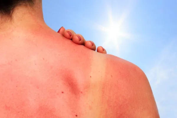 No es protector solar: los trucos para cuidar la piel del sol en verano