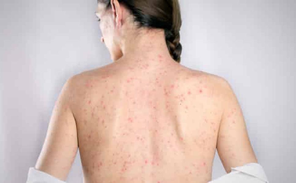 Sífilis: los síntomas de una enfermedad que puede ser silenciosa