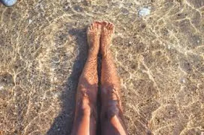 ¿Por qué las várices empeoran en el verano?