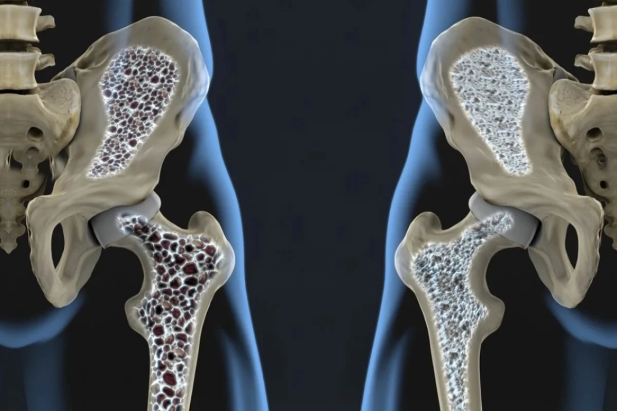 ¿Cómo prevenir la osteoporosis con la actividad física?