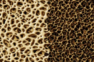 Osteopenia: cómo prevenir la pérdida ósea según el método de Harvard