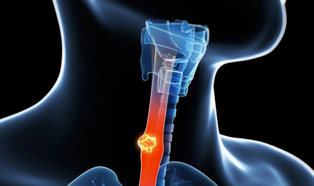 Fcatores de riesgo en el cáncer de esófago