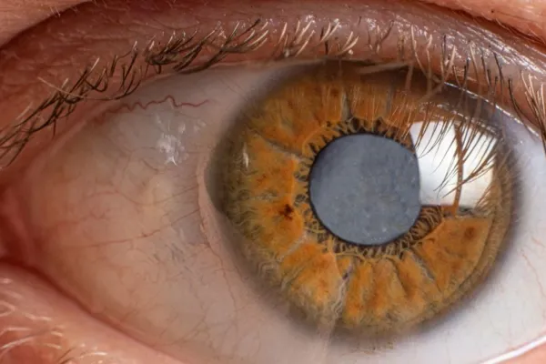 Día Mundial del Glaucoma: cómo detectar la enfermedad que puede provocar ceguera irreversible