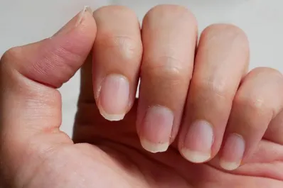 Cáncer de pulmón: el desconocido síntoma que se manifiesta en las uñas