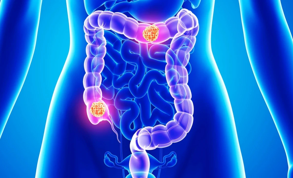 ¿Cómo identificar el cáncer de colon?