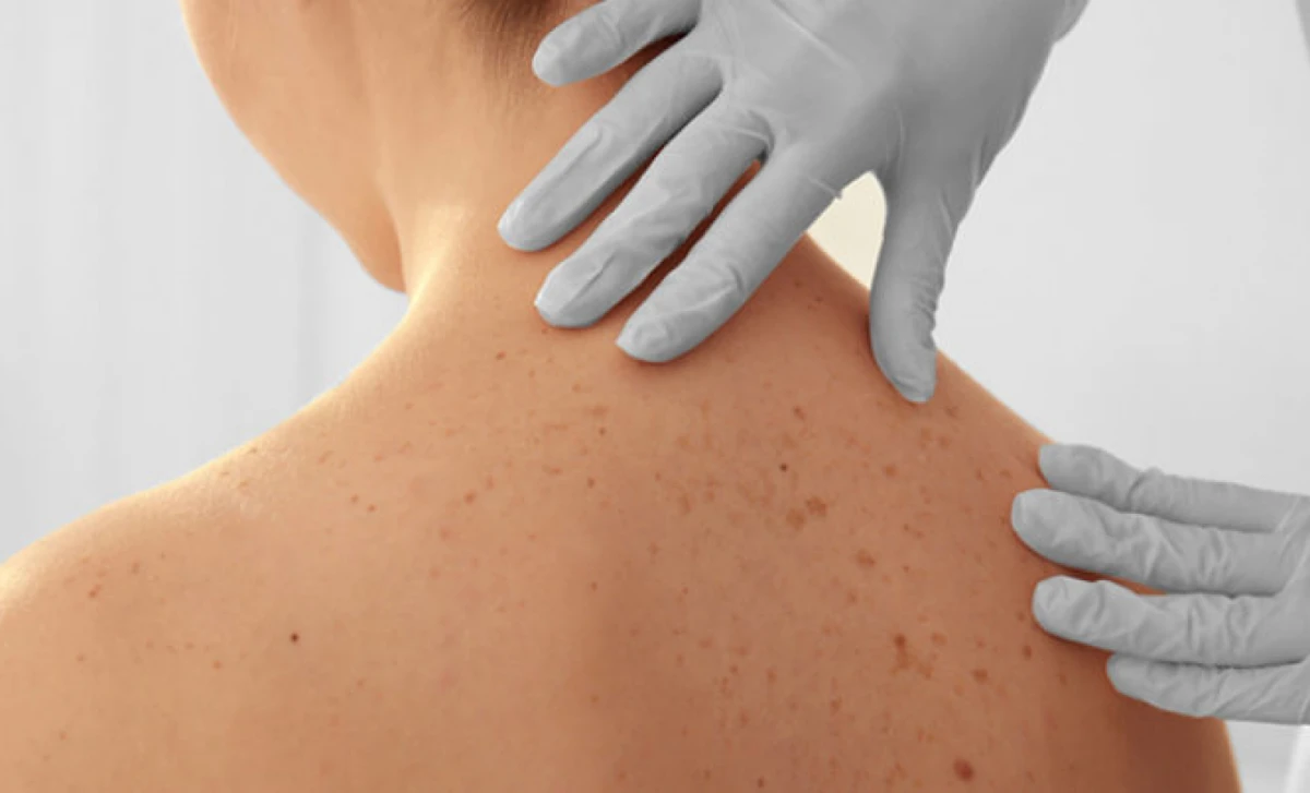 ¿Cómo identificar lunares malignos?