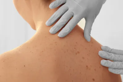 Cómo saber si un lunar es normal o indica algún peligro