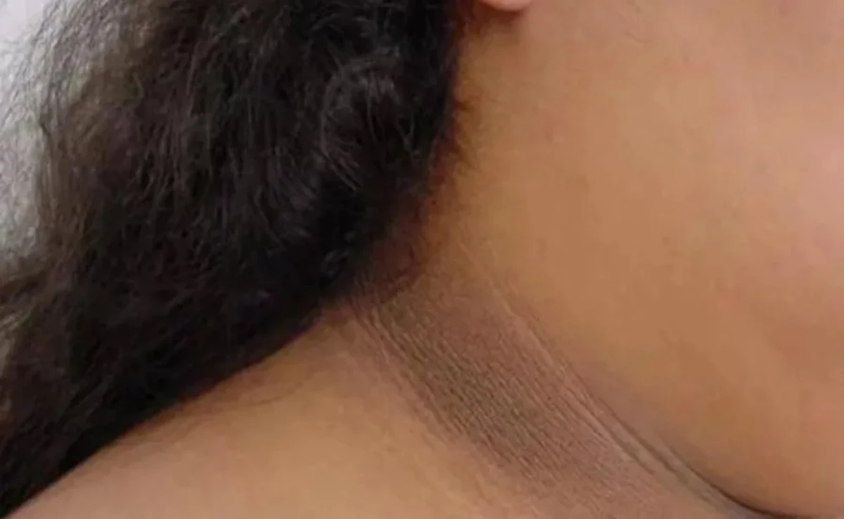 ¿Manchas oscuras en cuello, axilas o entrepierna? podría ser más que un problema estético