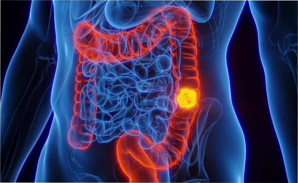 Frutos secos que pueden reducir el riesgo de cáncer de colon.