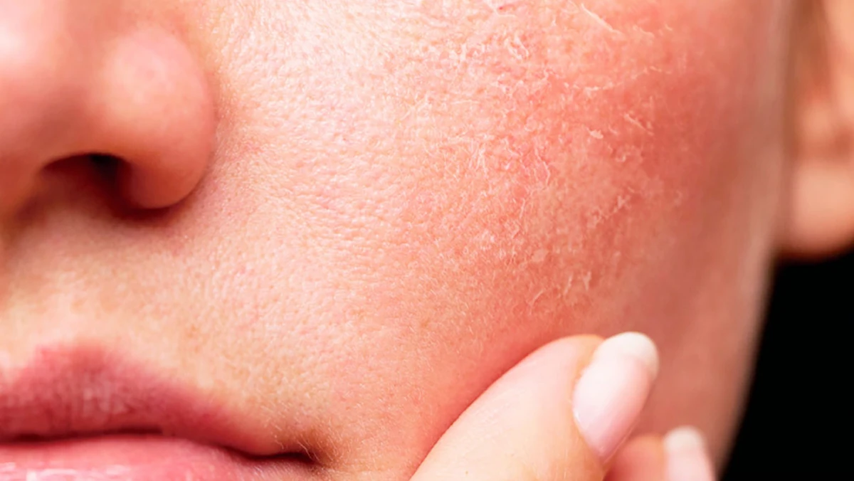 Piel deshidratada: eliminá esta práctica en la ducha para cuidarte en invierno