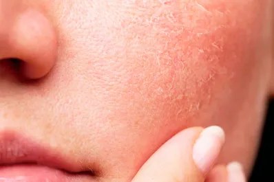 Piel deshidratada: eliminá esta práctica en la ducha para cuidarte en invierno