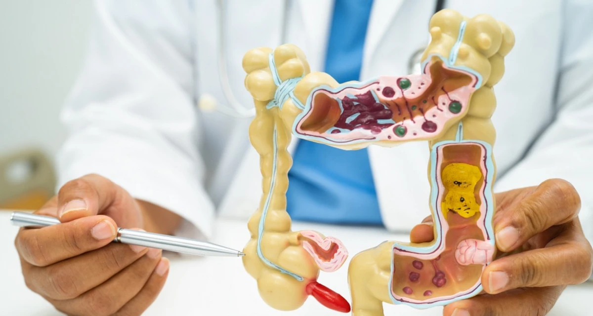 Cáncer de colon. MINISTERIO DE SALUD PÚBLICA 