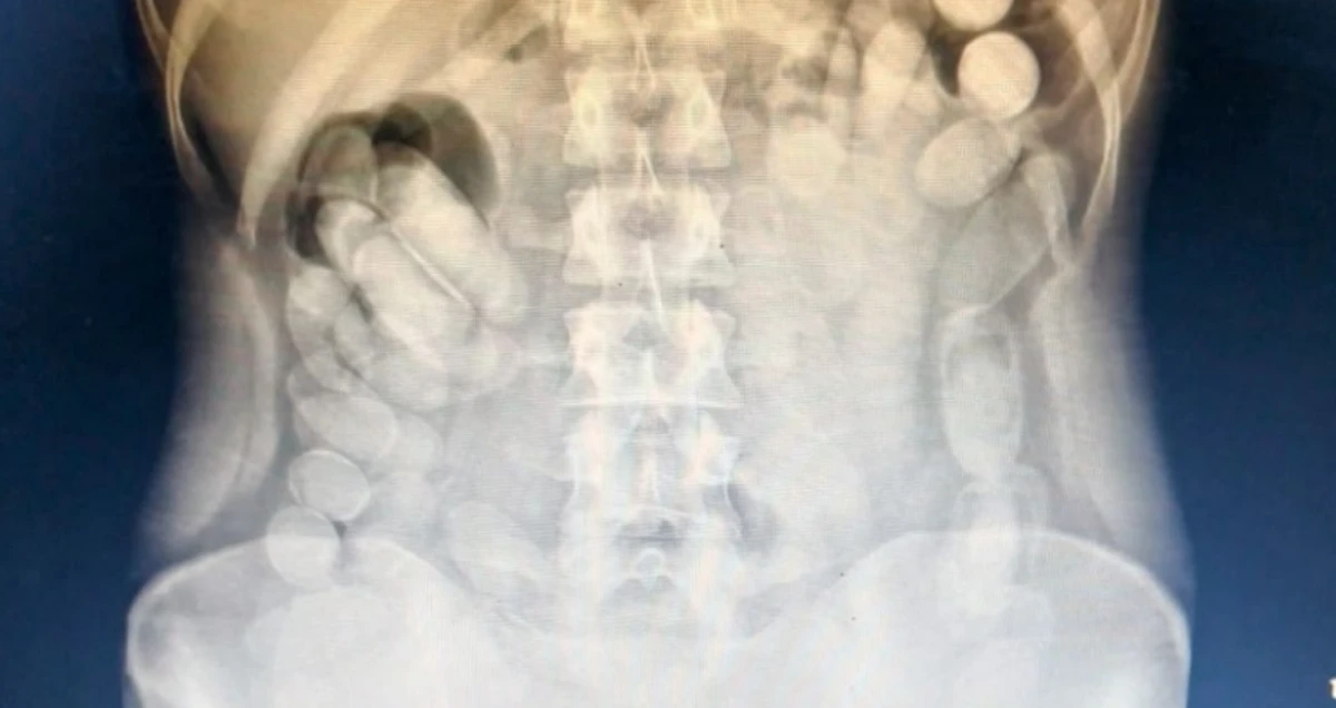 Detienen a una mujer en Tucumán con más de 100 cápsulas de cocaína en su estómago