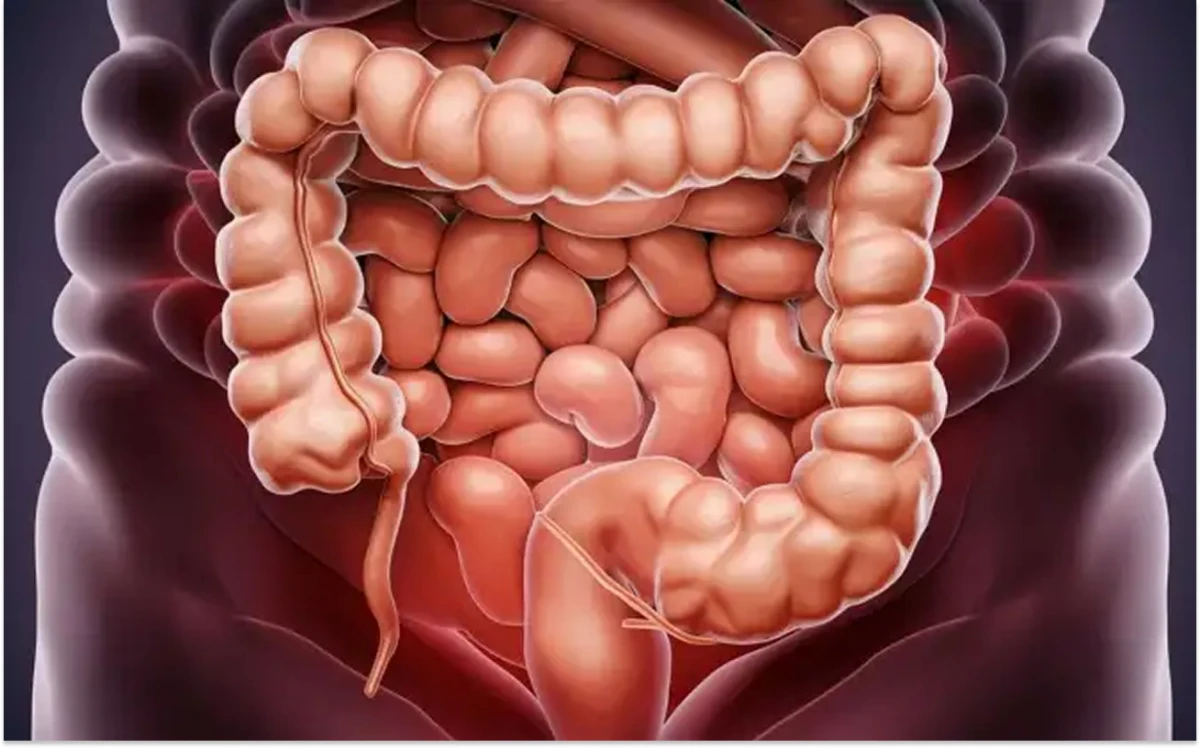 Cáncer colorrectal: Argentina cuenta con los índices más altos de la región y podría estar relacionado con la dieta