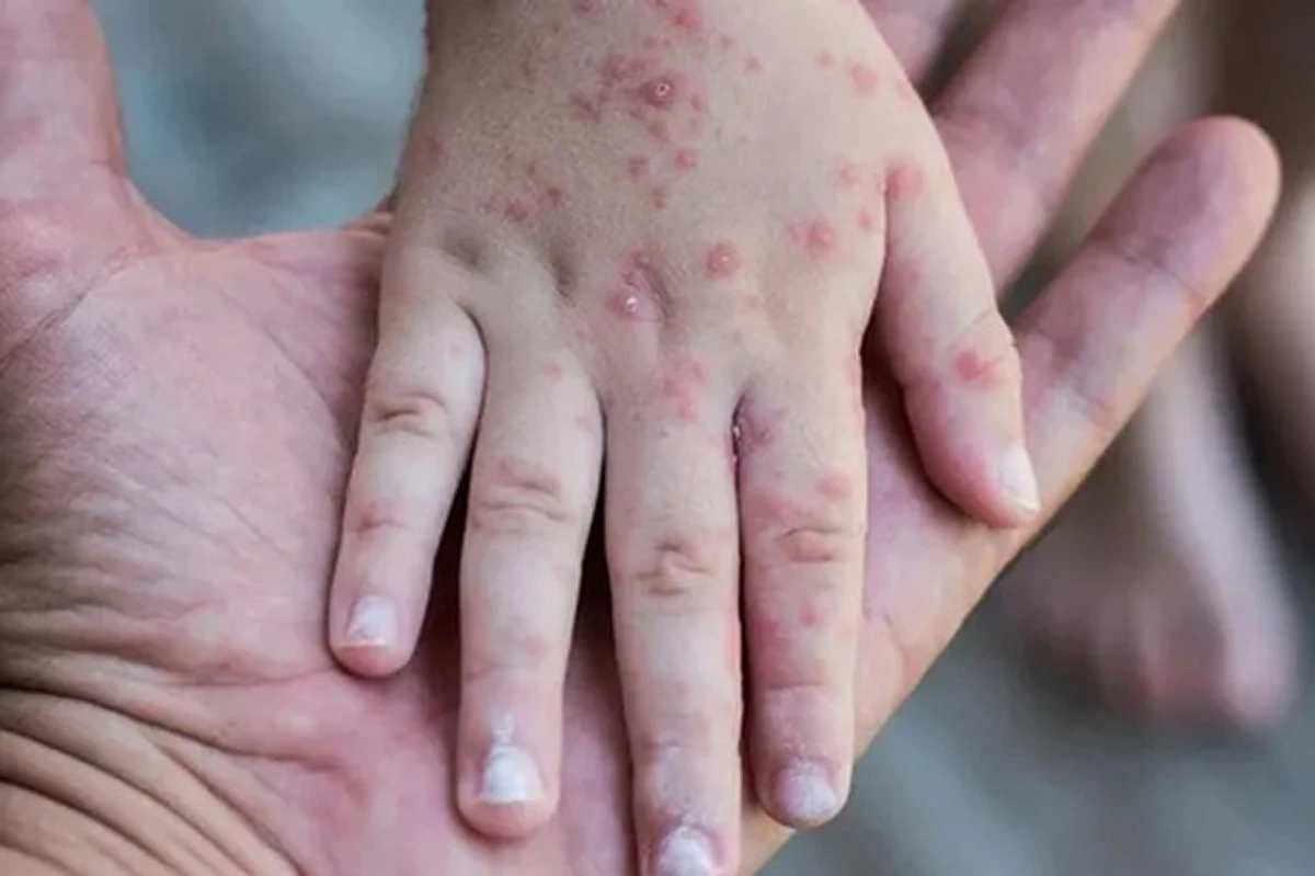 Una buena noticia para Tucumán: la provincia registró menos casos de sarampión de lo esperado