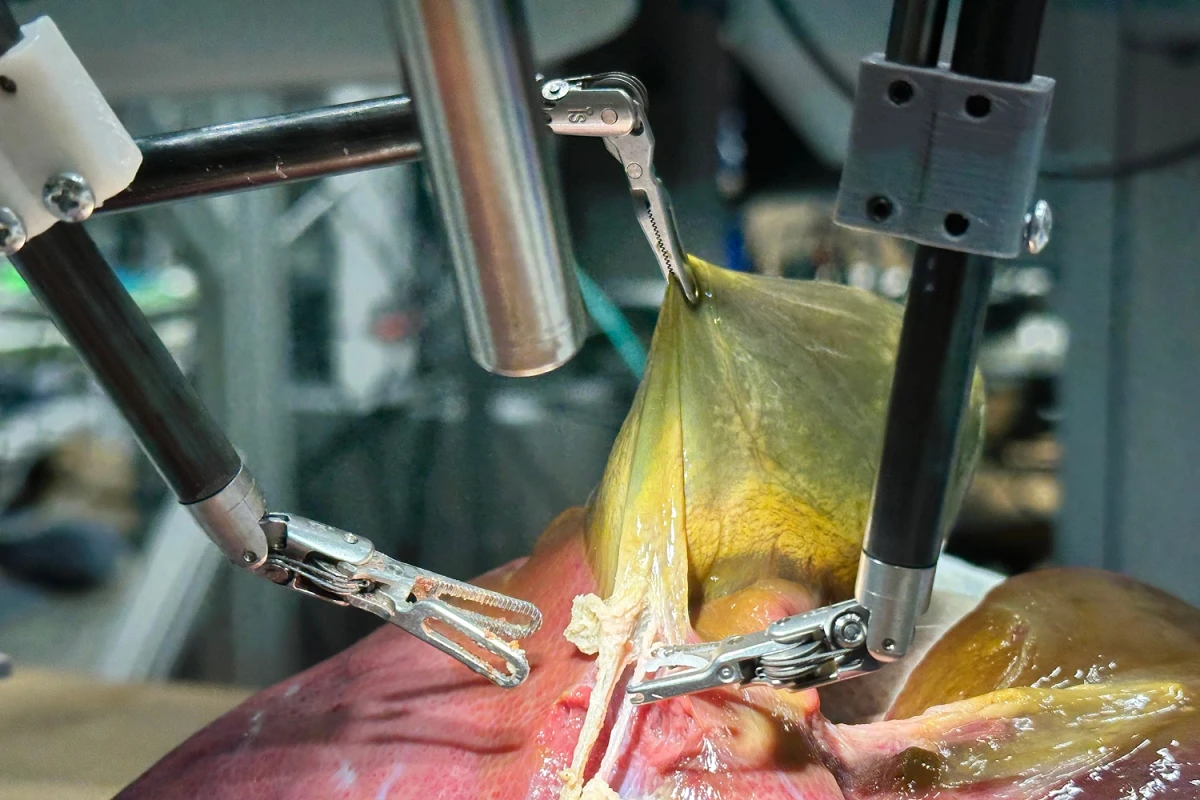 CIENCIA MÉDICA. Un robot entrenado con IA realizó con éxito una parte compleja de una cirugía sin intervención humana.