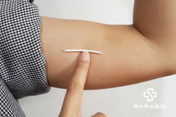 Anticonceptivos: ganan terreno los métodos de larga duración