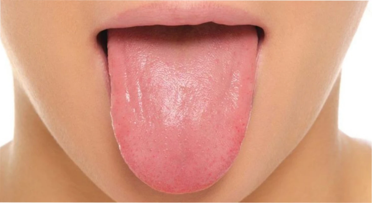 Cáncer de lengua, los signos sutiles que pueden alertar esta enfermedad.