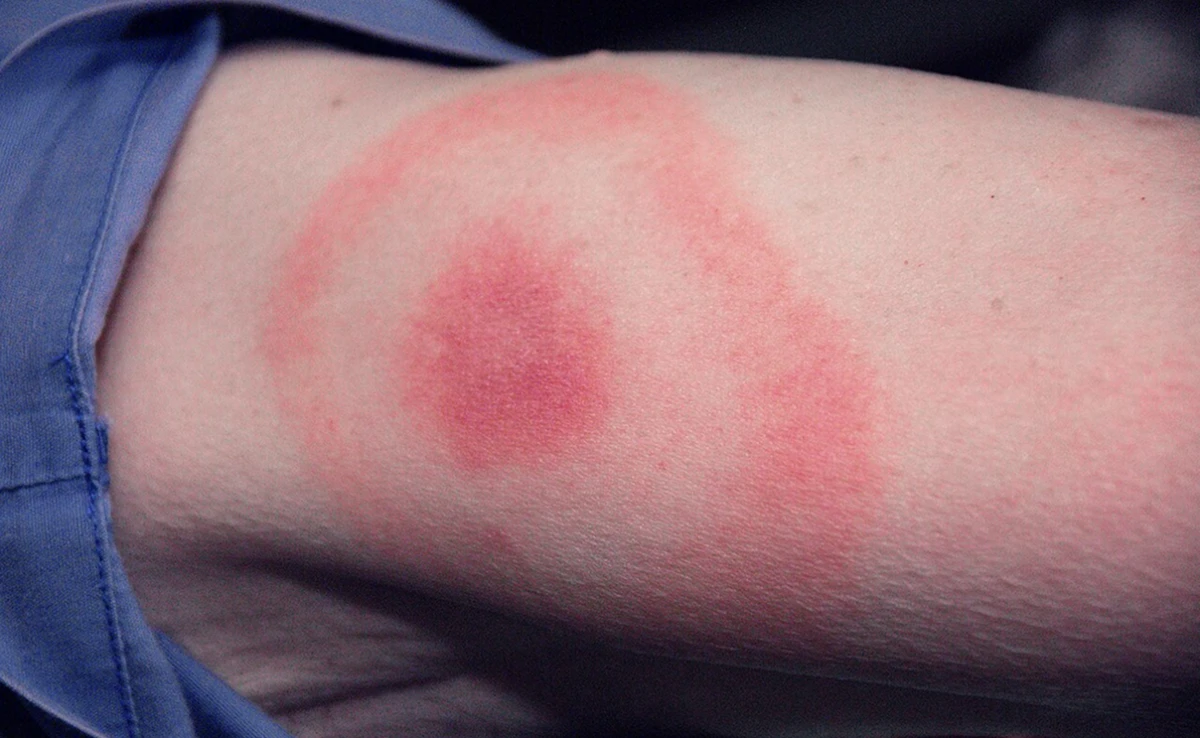 Cómo se contagia la enfermedad de Lyme: el diagnóstico que recibieron Justin Timberlake, Thalía y Justin Bieber