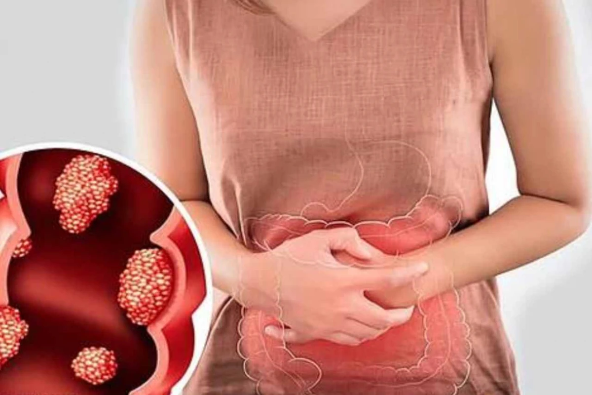 Cáncer de colon: el síntoma clave que todos ignoran pero puede salvar tu vida