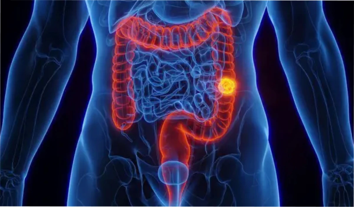 Cáncer de colon: los signos ocultos de la enfermedad.