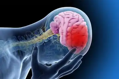 Los cinco síntomas que podrían indicar un ACV y nunca deben subestimarse, según un neurólogo