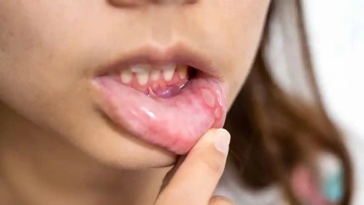 El síntoma que aparece en la boca y podría ser señal de un cáncer mortal, según un experto