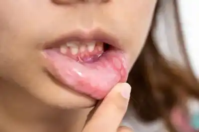 El síntoma que aparece en la boca y podría ser señal de un cáncer mortal, según un experto