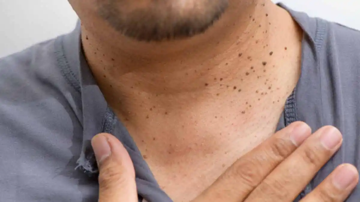 Por qué aparecen pequeñas verrugas con la edad y cómo quitarlas