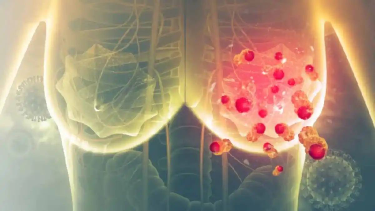 Cáncer de mama: cuáles son los primeros síntomas y cómo identificarlos a tiempo