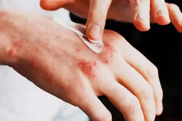 Dermatitis atópica: el peso de las demoras
