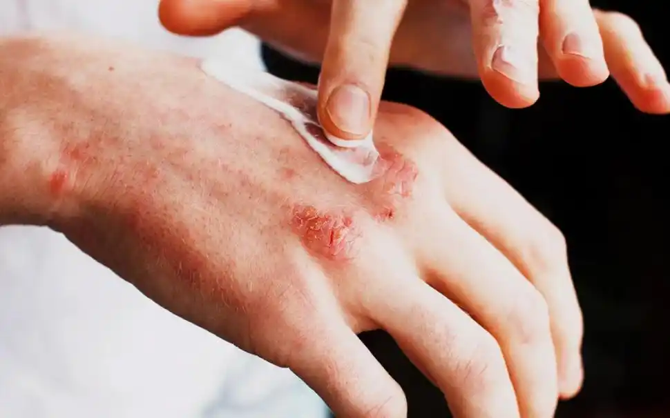 Dermatitis atópica: el peso de las demoras