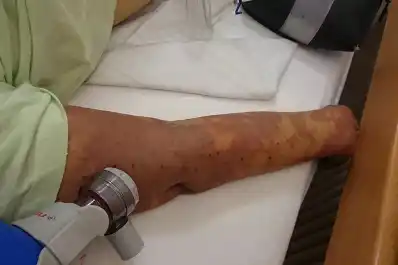 Sepsis: cómo reconocer la enfermedad, muchas veces silenciosa, que puede causar la muerte