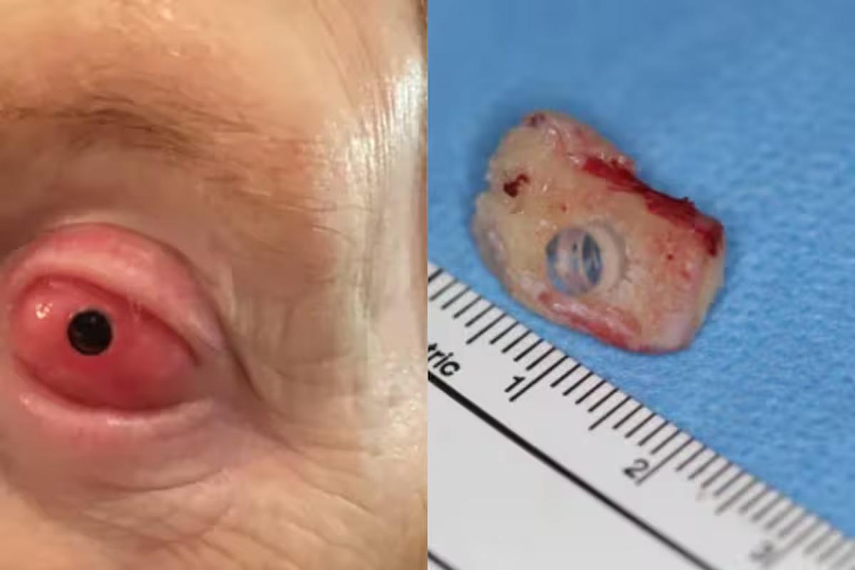 CIENCIA. En Vancouver realizaron una cirugía ocular con un diente humano que permitió recuperar la visión tras dos décadas de ceguera.