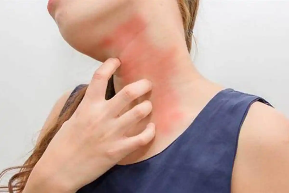 Uno de los sínomas que puede producir este tipo de alergia es la picazón o enrojecimiento de la piel.