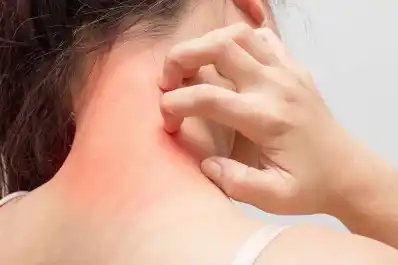 Qué hacer con la piel irritada por alergias: las cremas y tratamientos que recomiendan los especialistas