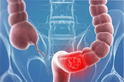 Un medicamento común puede acabar con el cáncer de colon, según un nuevo estudio