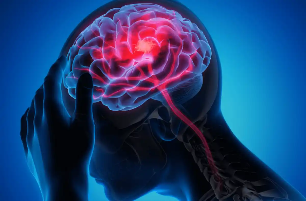 Día de la Hipertensión Intracraneal Idiopática, la enfermedad que simula ser un tumor