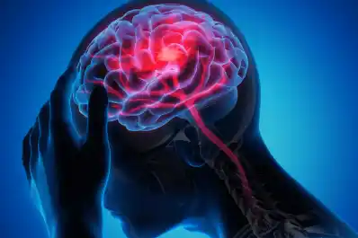 Día de la Hipertensión Intracraneal Idiopática, la enfermedad que simula ser un tumor