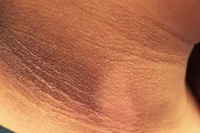 Verrugas y manchas oscuras en el cuello: la señal que podría anticipar una grave enfermedad