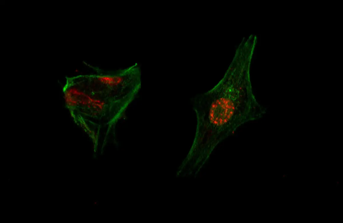 Los virus oncolíticos, diseñados por el equipo de investigación del Conicet y del Instituto Leloir, reconocen células tumorales, las infectan y las destruyen.