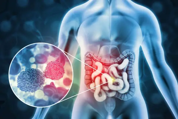 Cáncer colorrectal: un hallazgo prometedor que exige ir paso a paso